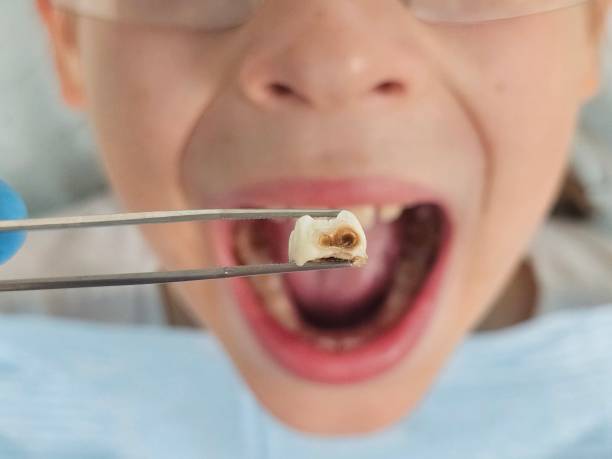 Best Cracked Tooth Emergency Dentist  in Bonny Doon, CA